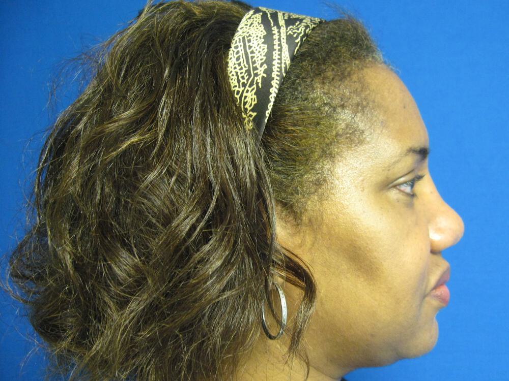 African American Rhinoplasty Before & After Image