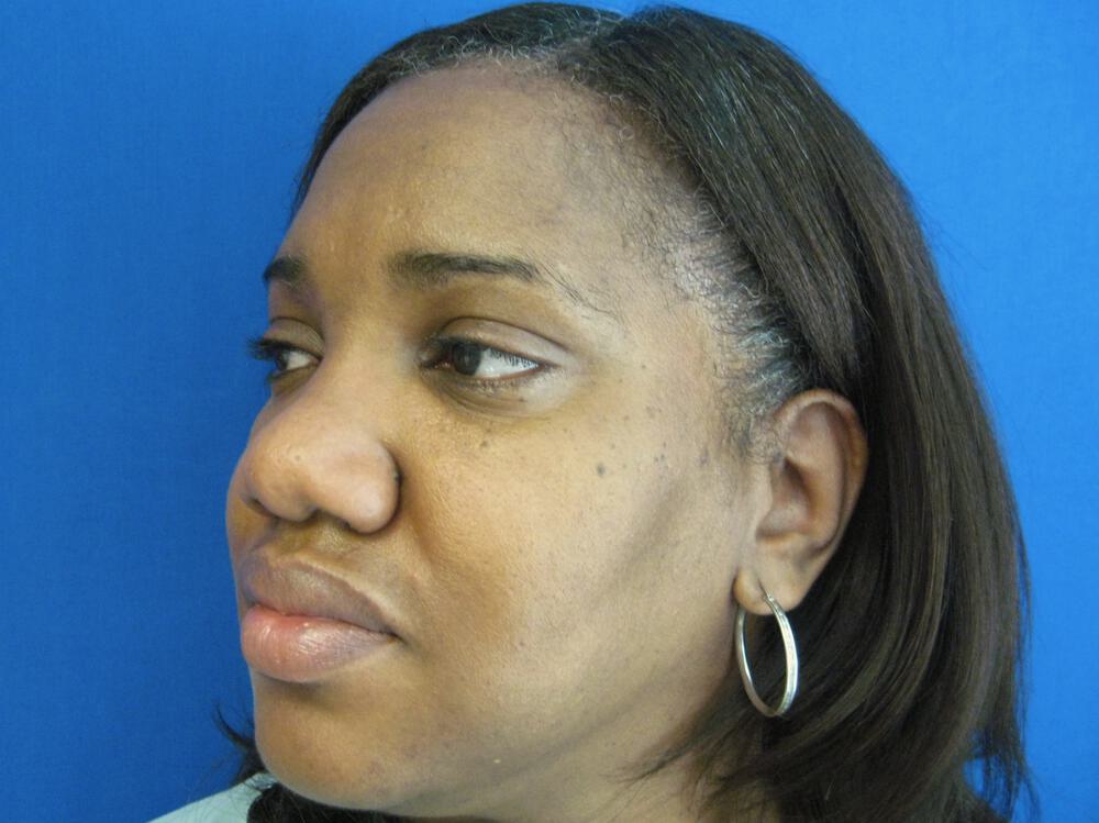 African American Rhinoplasty Before & After Image