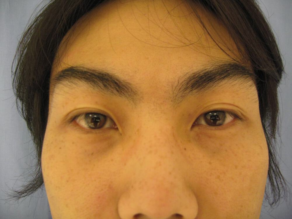 Asian Eyelid Surgery Before & After Image
