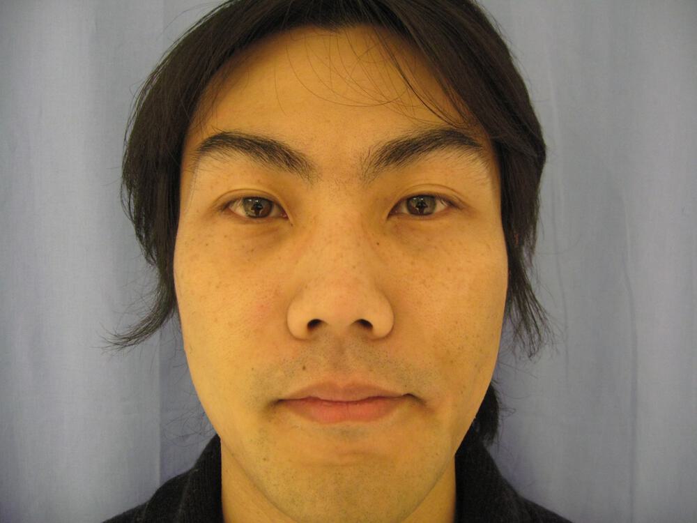 Asian Eyelid Surgery Before & After Image