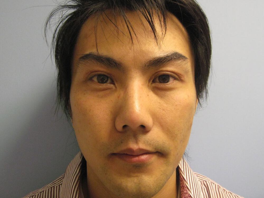 Asian Eyelid Surgery Before & After Image