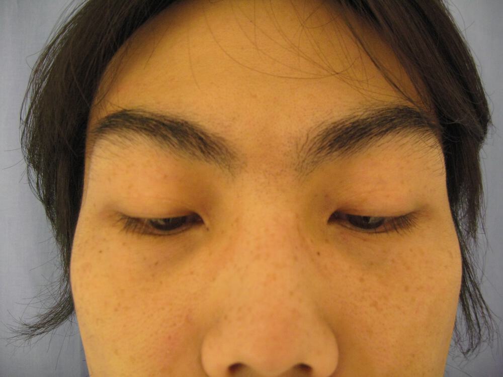 Asian Eyelid Surgery Before & After Image