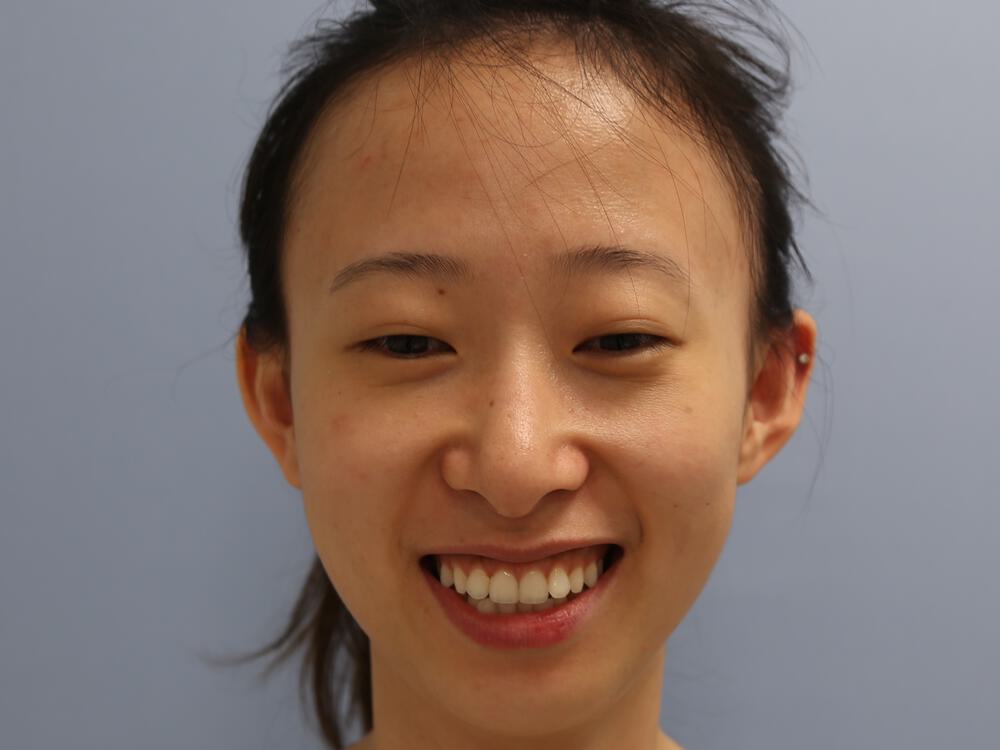 Asian Eyelid Surgery Before & After Image