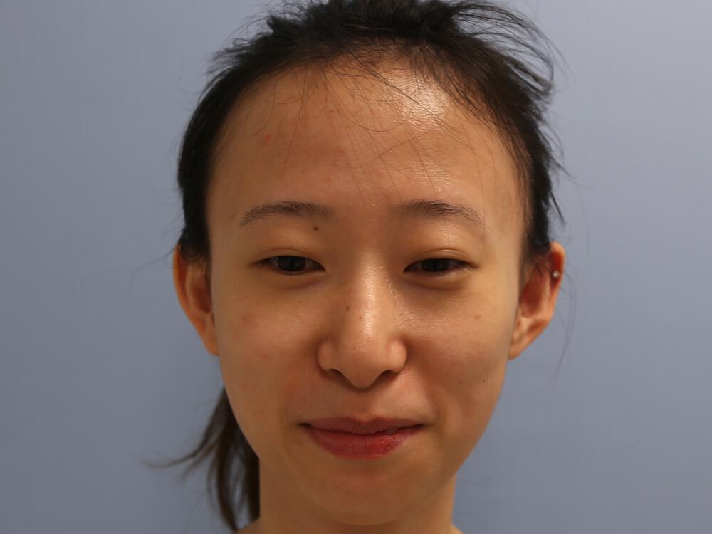 Asian Eyelid Surgery Before & After Image