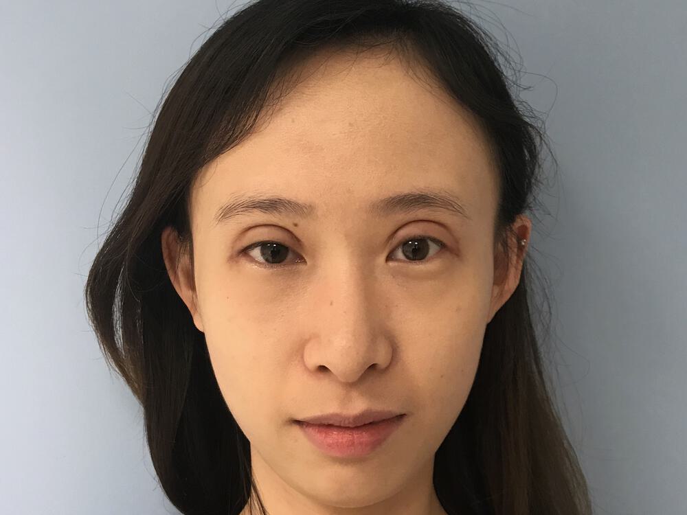 Asian Eyelid Surgery Before & After Image