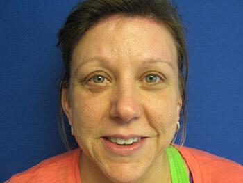 Brow Lift Before & After Image