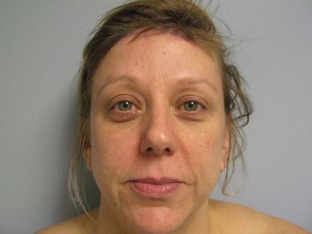 Brow Lift Before & After Image