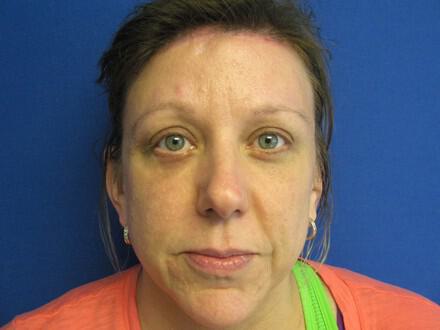 Brow Lift Before & After Image