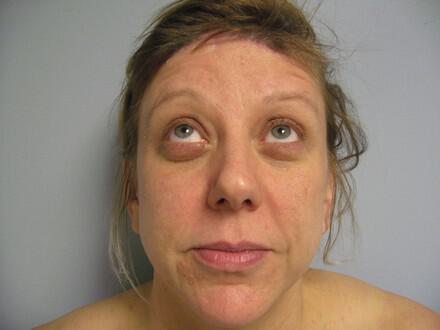 Brow Lift Before & After Image