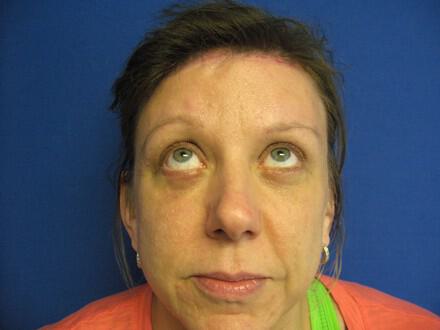 Brow Lift Before & After Image