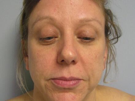 Brow Lift Before & After Image