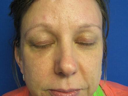 Brow Lift Before & After Image