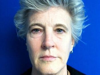 Brow Lift Before & After Image