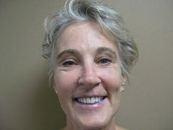 Brow Lift Before & After Image