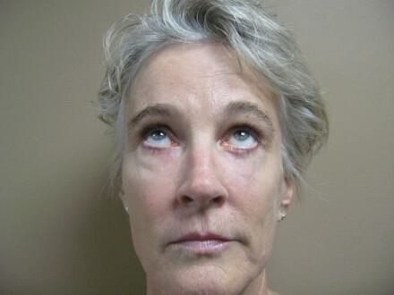 Brow Lift Before & After Image