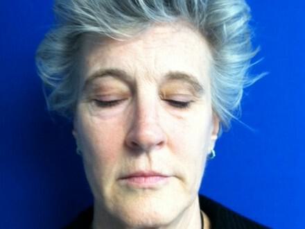 Brow Lift Before & After Image