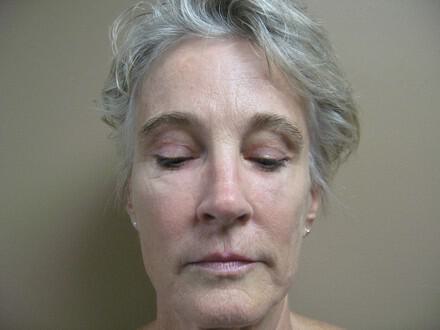 Brow Lift Before & After Image