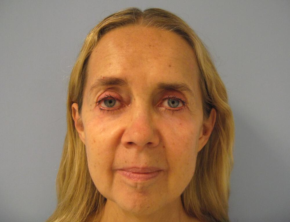 Browlift Before & After Image