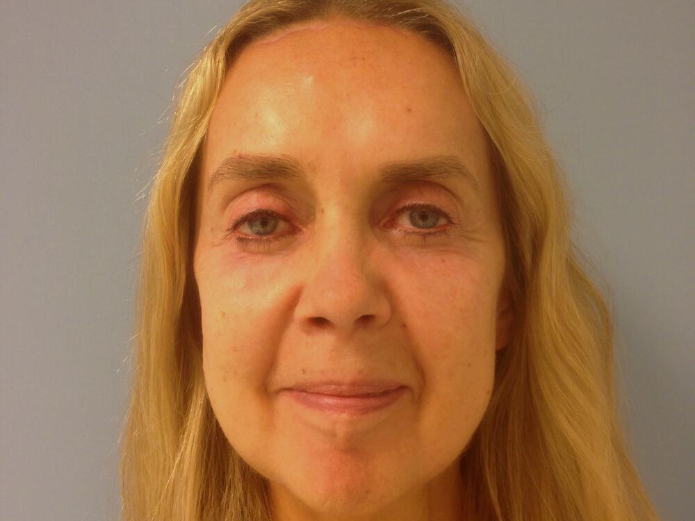 Browlift Before & After Image