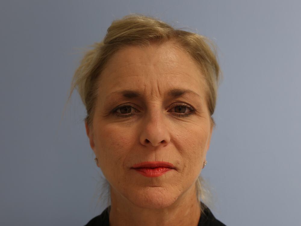 Browlift Before & After Image