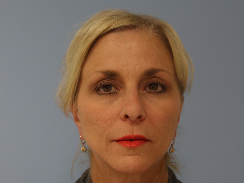 Browlift Before & After Image