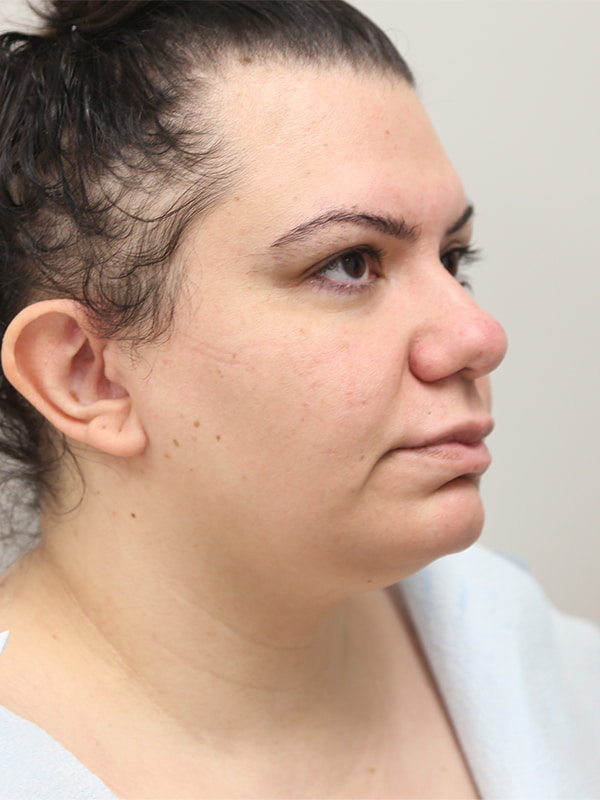 Browlift Before & After Image