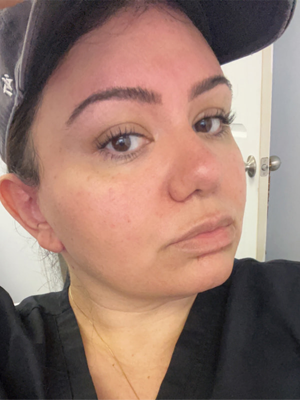 Browlift Before & After Image