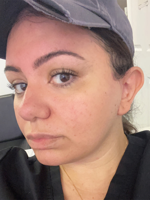 Brow Lift Before & After Image