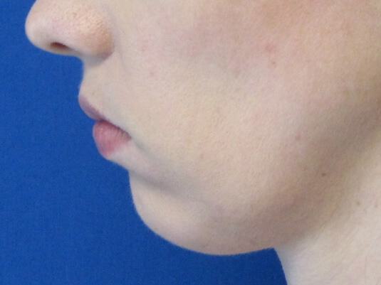 Chin Surgery Before & After Image