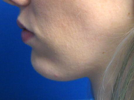 Chin Surgery Before & After Image