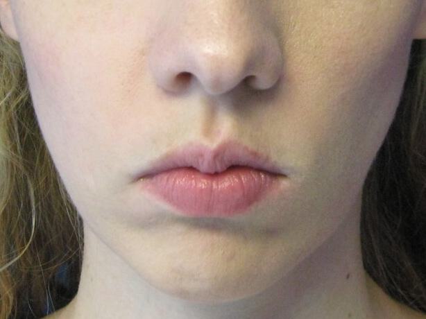Chin Surgery Before & After Image