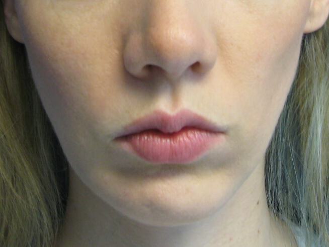 Chin Surgery Before & After Image