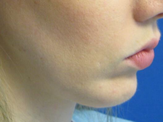Chin Surgery Before & After Image