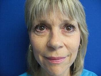 Blepharoplasty Before & After Image