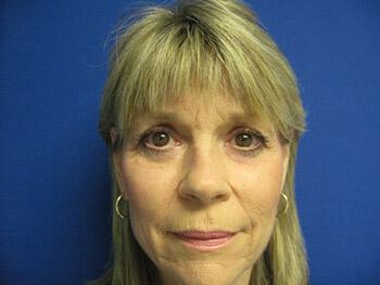 Blepharoplasty Before & After Image