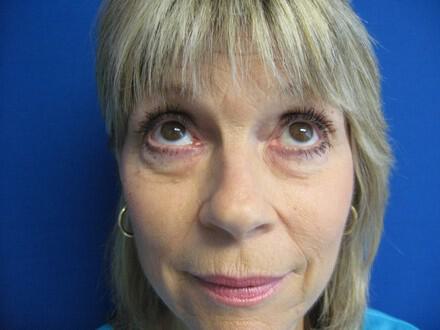 Blepharoplasty Before & After Image