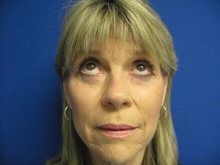 Blepharoplasty Before & After Image