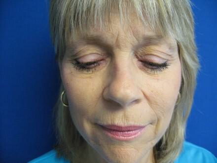 Blepharoplasty Before & After Image