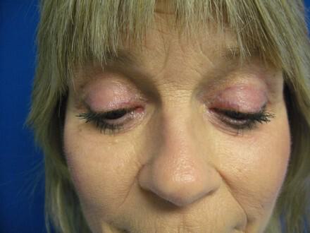 Blepharoplasty Before & After Image