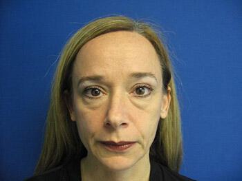 Blepharoplasty Before & After Image