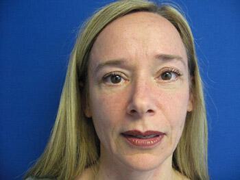 Blepharoplasty Before & After Image