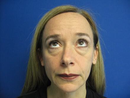 Blepharoplasty Before & After Image