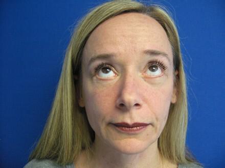 Blepharoplasty Before & After Image