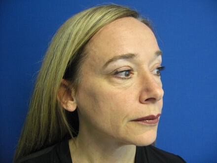 Blepharoplasty Before & After Image