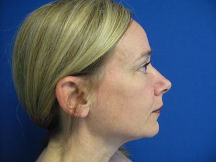 Blepharoplasty Before & After Image