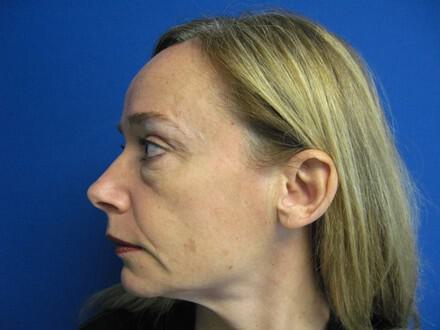 Blepharoplasty Before & After Image