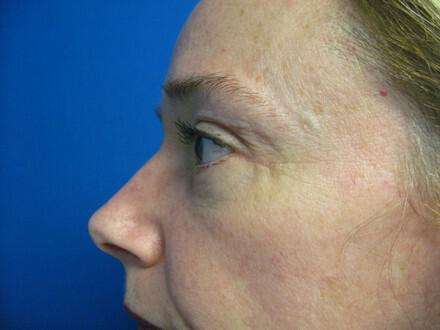 Blepharoplasty Before & After Image