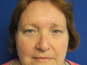 Blepharoplasty Before & After Image