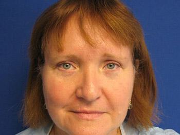 Blepharoplasty Before & After Image