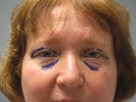 Blepharoplasty Before & After Image